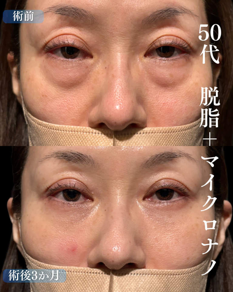 50代女性　脱脂+脂肪注入